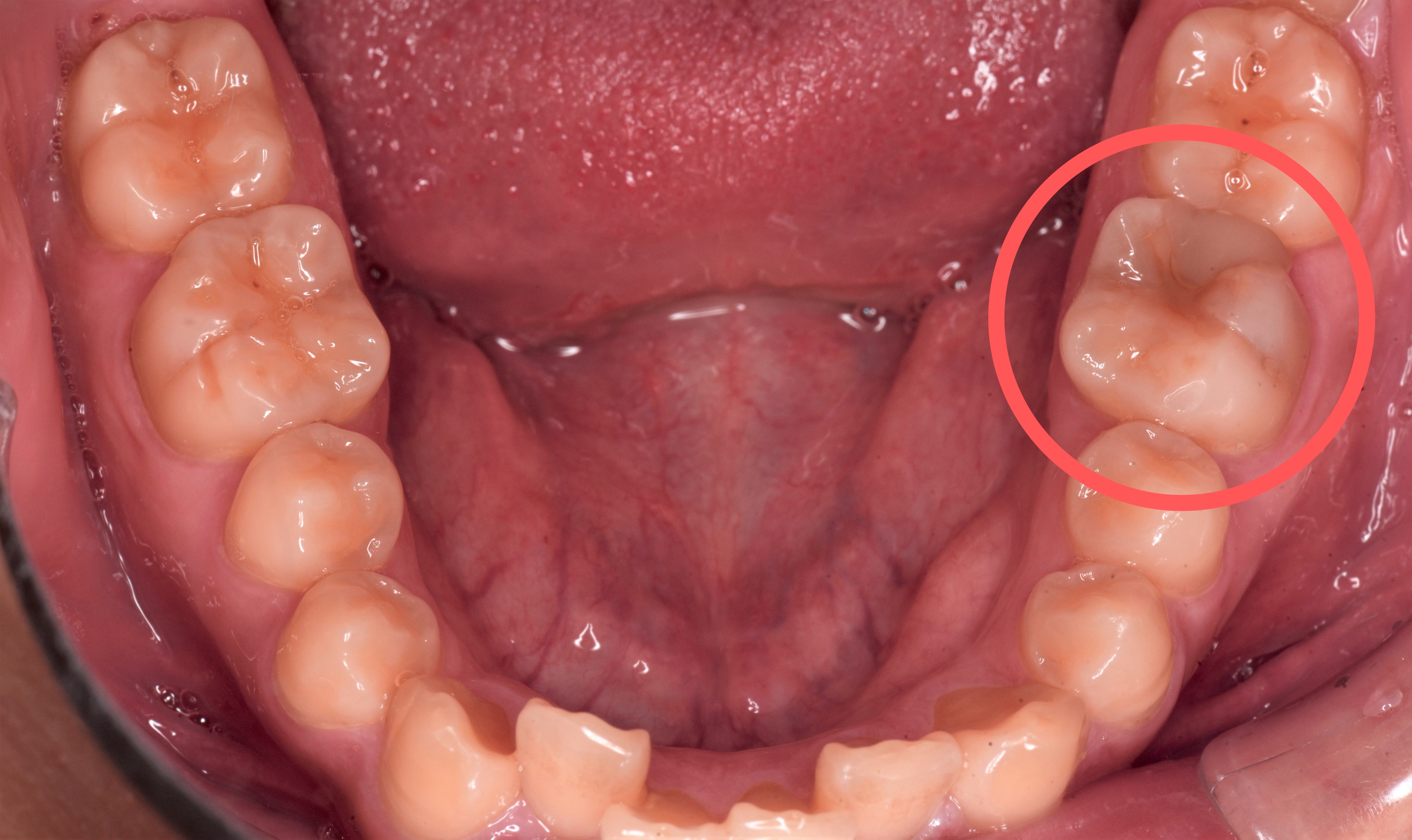 虫歯治療の症例