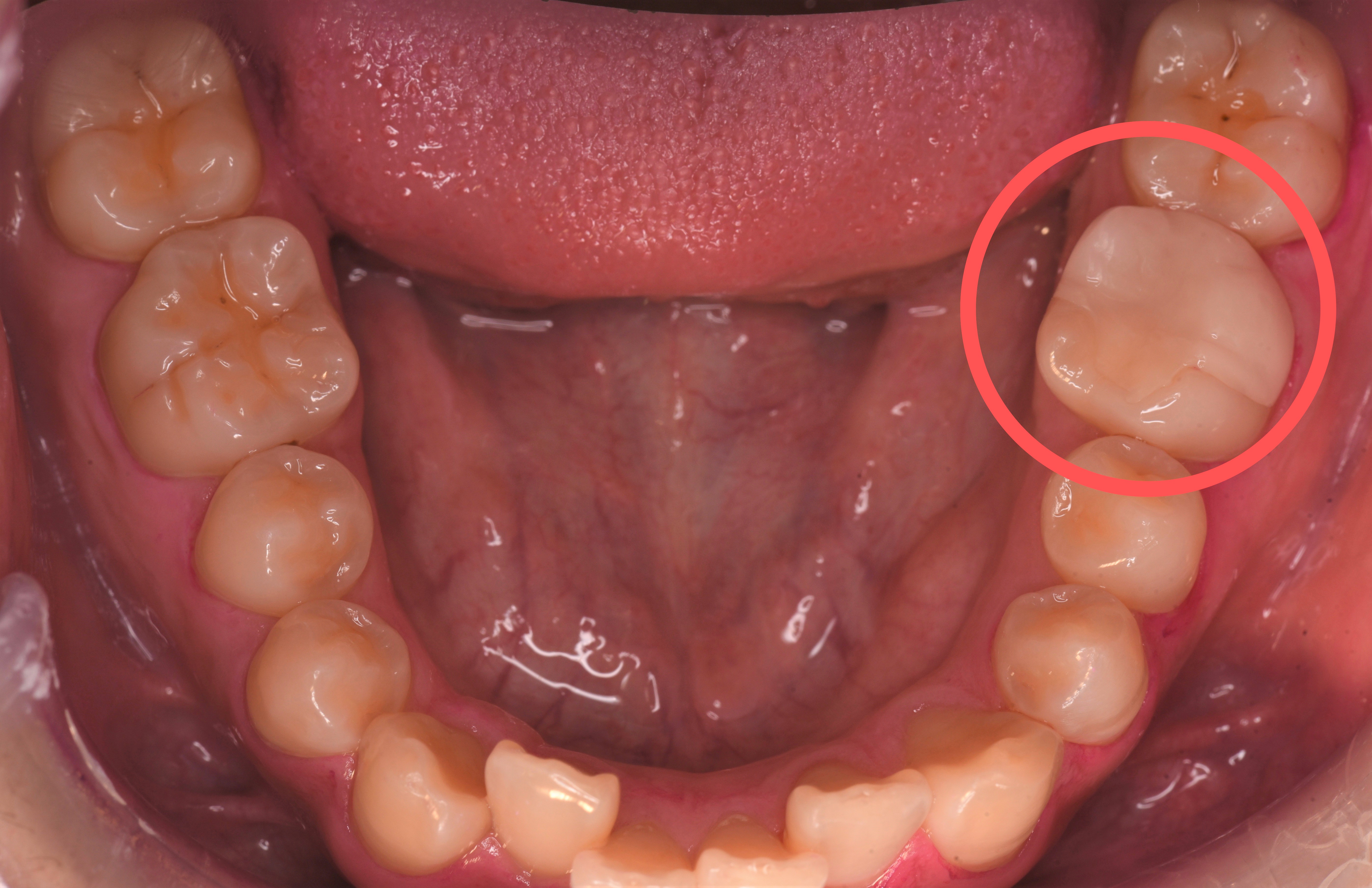 虫歯治療の症例
