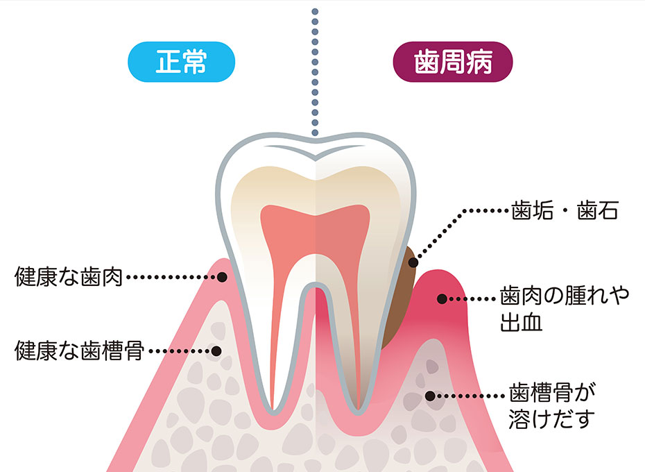 歯周病とは