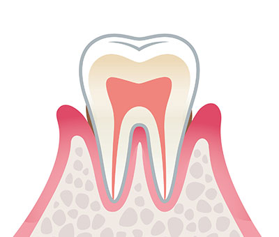 2.軽度の歯周病