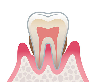 3.中程度の歯周病