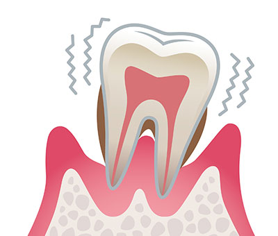 4.重度の歯周病